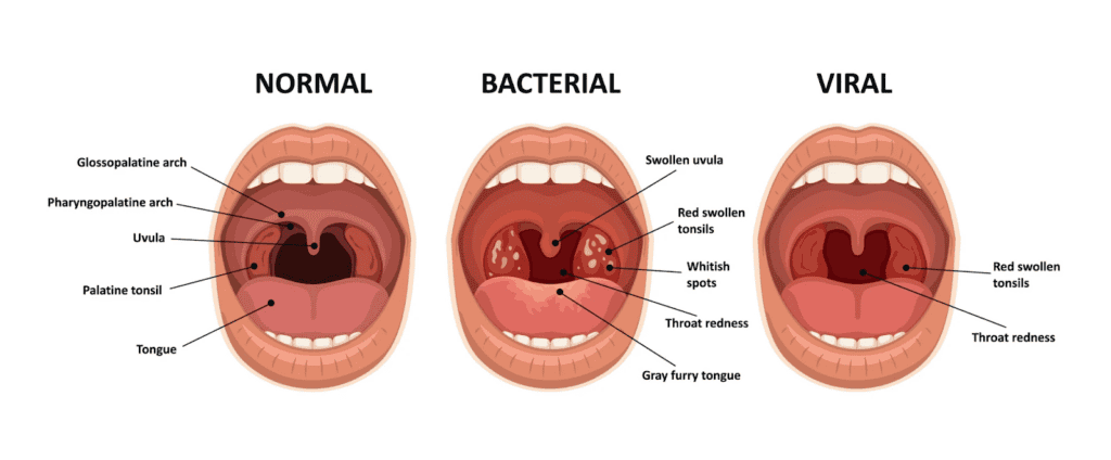 What Causes a Sore Throat