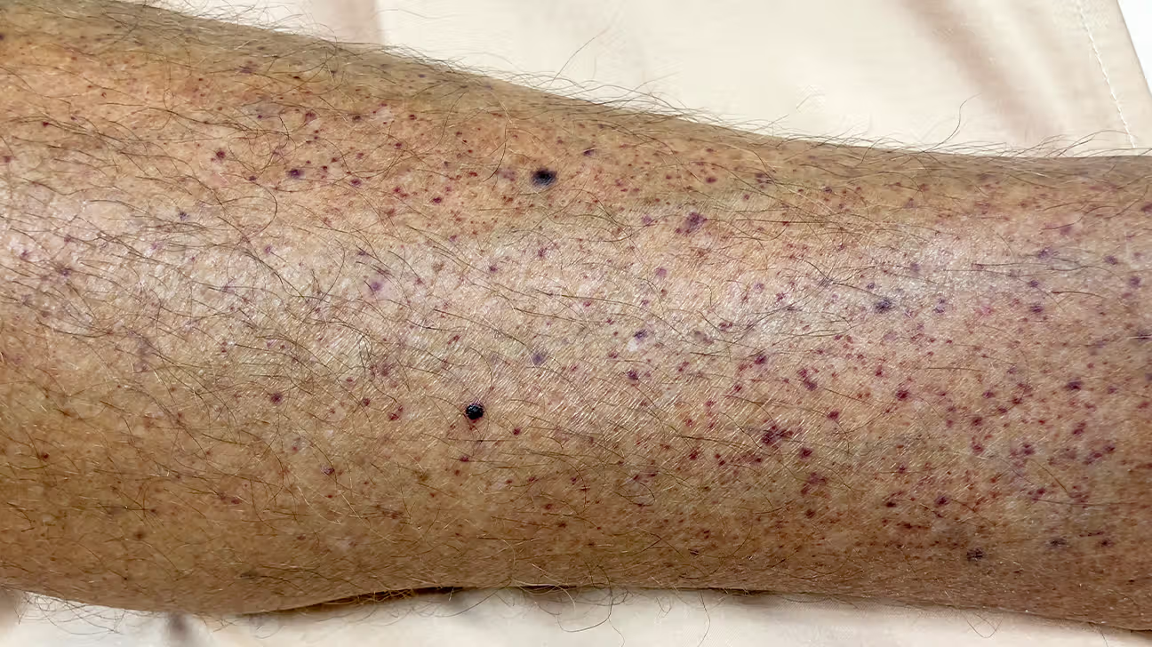 Petechiae