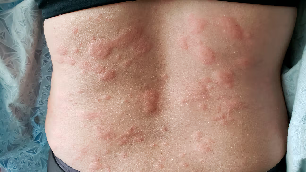 Allergic Reactions and Rashes