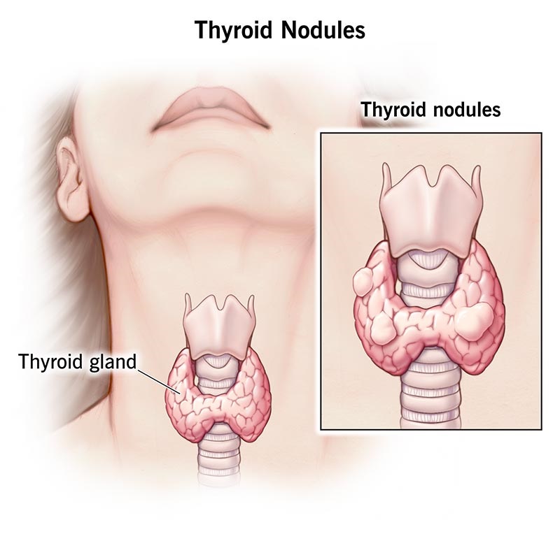 Thyroid Nodules