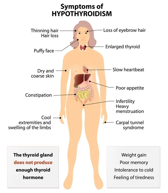 Hyperthyroidism (Overactive Thyroid)