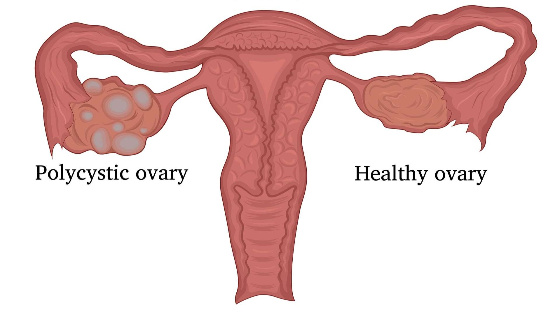 What Is PCOD and How Is It Different From PCOS