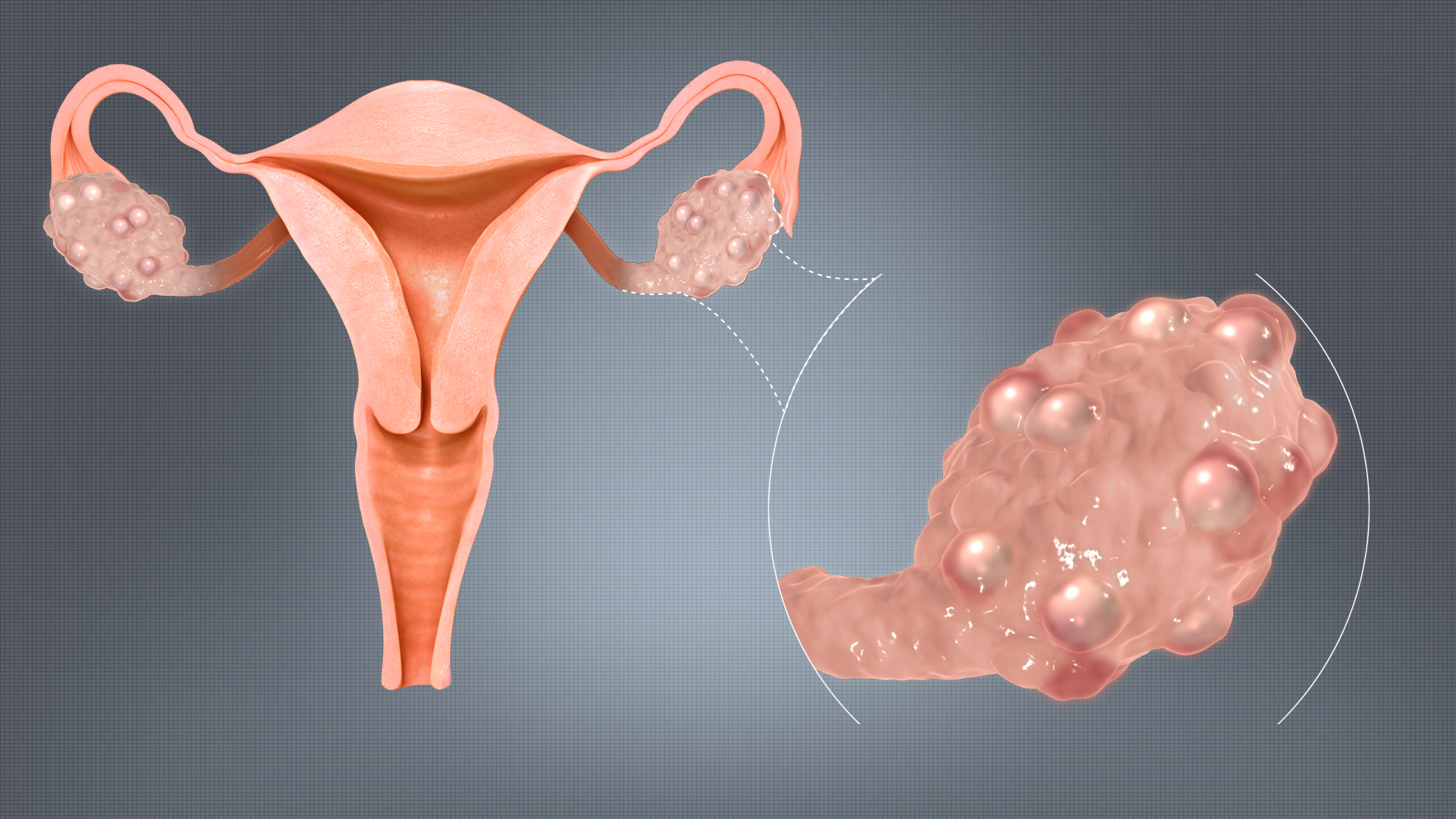 What Is PCOS and How Does It Affect the Body?